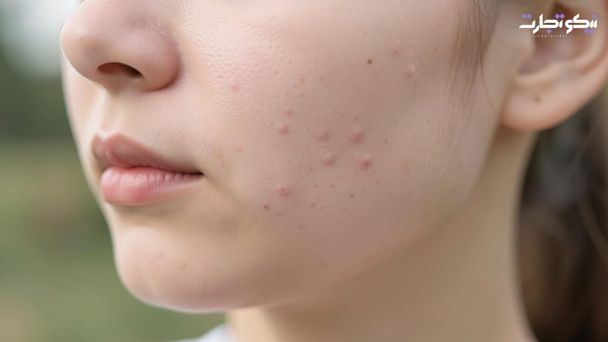 چرا دچار جوش زیر پوستی می_شویم؟ بررسی علت_ها