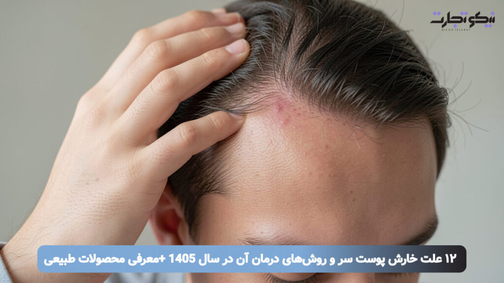 ۱۲ علت خارش پوست سر و روش‌های درمان آن در سال 1405 +معرفی محصولات طبیعی